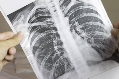 Fluorography holding eller kırpılmış, x-ışını. Akciğer desease kavramı