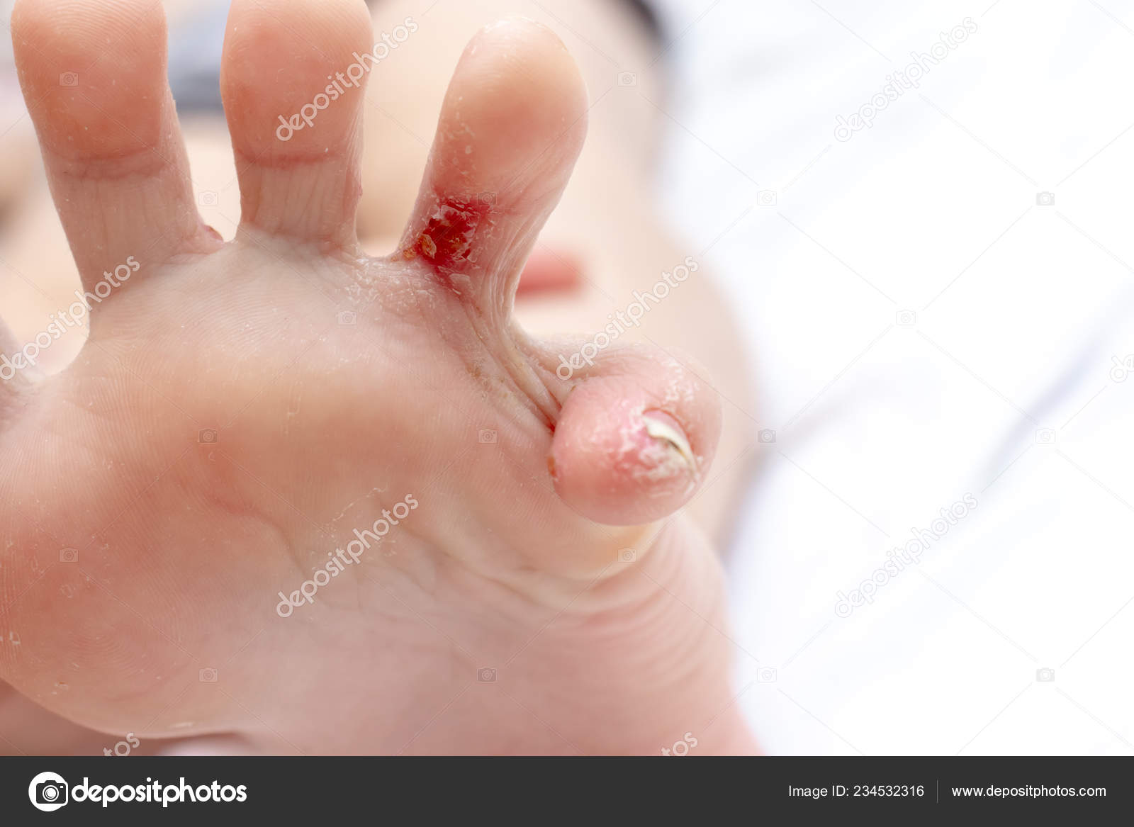 baby foot peel eczema