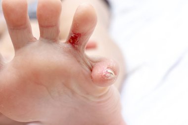Dyshydrotic egzama, atopik dermatit yaralanma, zarar üzerinde ayak ve ayak parmakları bir çocuk. Dermatoloji ve Pediatri kavramı. Mantar enfeksiyonu tedavi.