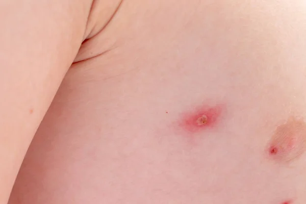 Close Beeld Van Huid Van Kaukasische Jongen Met Varicella Virus — Stockfoto