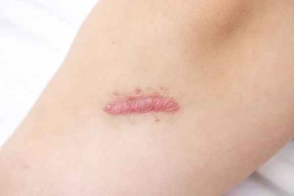 Close Cicatriz Queloide Cianótica Perna Causada Por Cirurgia Sutura Imperfeições — Fotografia de Stock