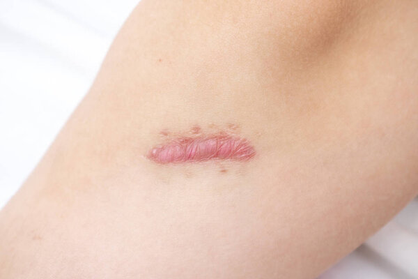Close up of cyanotic keloid scar on leg caused by surgery and suturing, skin imperfections or defects. Hypertrophic Scar on skin, dermatology and cosmetology concept.