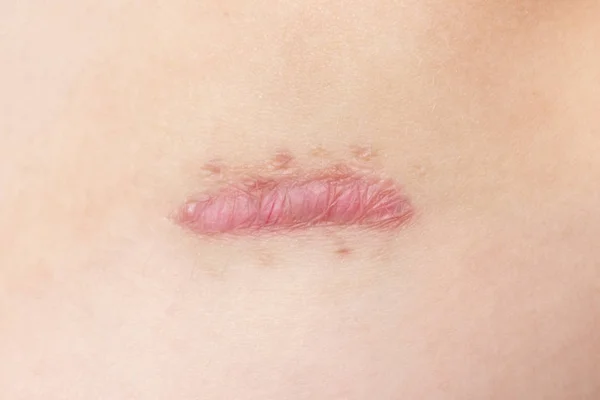 Close Cyanotic Keloid Scar Caused Surgery Suturing Skin Imperfections Defects — Stock Photo, Image