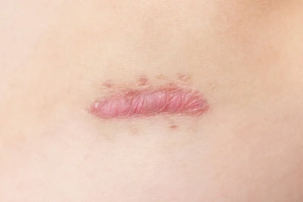 수술으로 Keloid Hypertrophic 피부과 개념에 — 스톡 사진