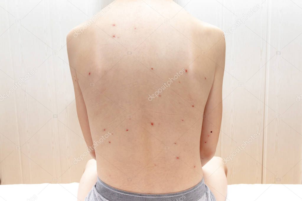 Closeup of back of boy with Varicella virus or Chickenpox. Bubble rash on child. Dermatology concept