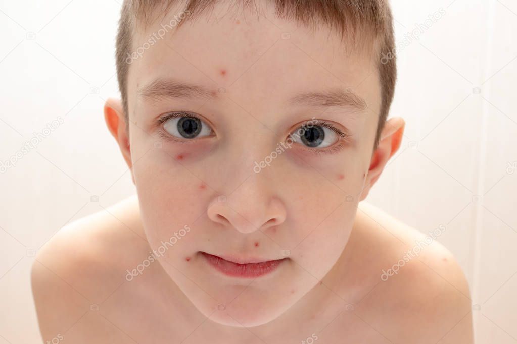 Face of caucasian boy with Varicella virus or Chickenpox, child with bubble rash close up. Dermatology and pediatrics concept