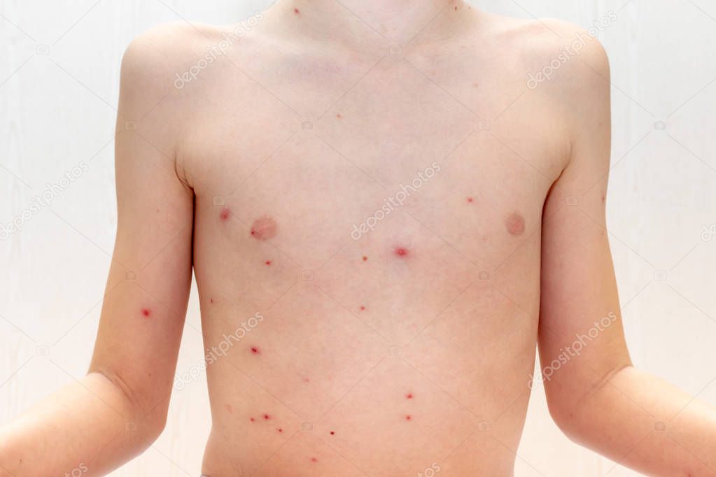 Body of caucasian boy with Varicella virus or Chickenpox, child with bubble rash close up. Dermatology and pediatrics concept