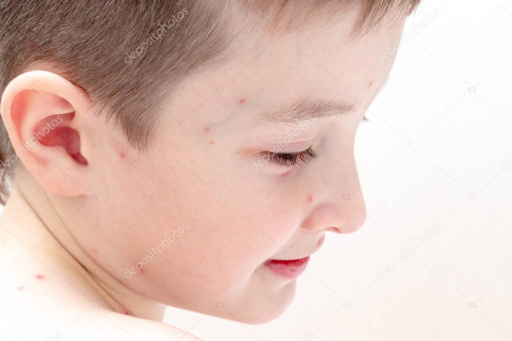 Face of caucasian boy with Varicella virus or Chickenpox, child with bubble rash close up. Dermatology and pediatrics concept