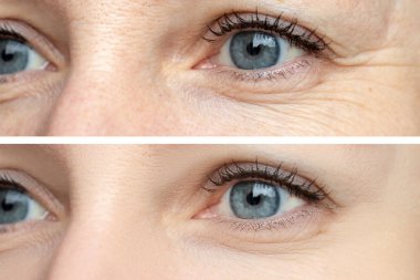 Kadın yüz, göz kırışıklıklar daha önce ve sonra tedavi - biorevitalization, botox ve pigment lekeleri kaldırma Kosmetoloji yordamlar gençleştirici sonucu