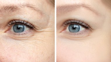 Kadın yüz, göz kırışıklıklar daha önce ve sonra tedavi - biorevitalization, botox ve pigment lekeleri kaldırma Kosmetoloji yordamlar gençleştirici sonucu