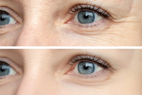 Woman face, eye wrinkles before and after treatment - the result of rejuvenating cosmetological procedures of biorevitalization, botox and pigment spots removal — Stock Photo, Image