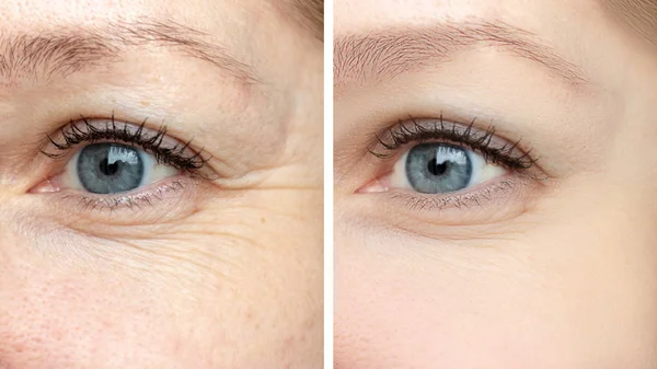 Woman face, eye wrinkles before and after treatment - the result of rejuvenating cosmetological procedures of biorevitalization, botox and pigment spots removal — Stock Photo, Image