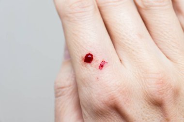 Dişi el üzerinde kanlı bir yara, cilt hasarı, yaralanma