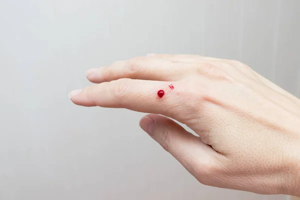 Una herida sangrienta en la mano femenina de cerca, daño en la piel, lesión —  Fotos de Stock