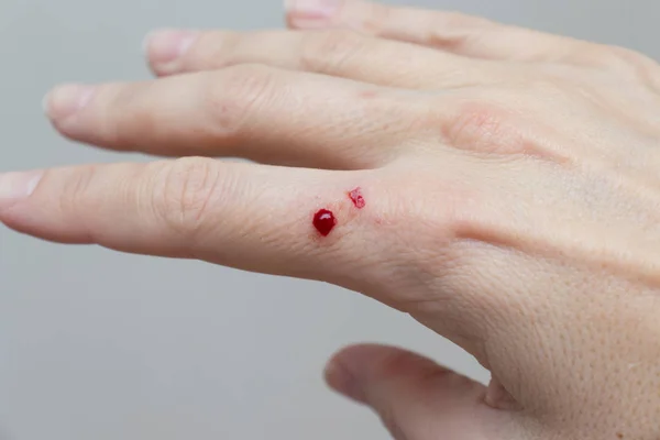 Krwawa rana na kobiecej dłoni z bliska, uszkodzenie skóry, uraz — Zdjęcie stockowe