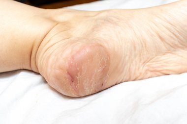 Hasarlı, çatlak, kuru ve ayak yakın bir topuk üzerinde cilt soyma, dermatolojik sorunlar ve mantar tedavisi