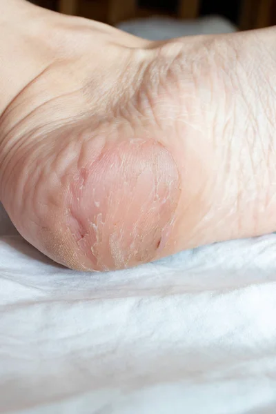 Hasarlı, çatlak, kuru ve ayak yakın bir topuk üzerinde cilt soyma, dermatolojik sorunlar ve mantar tedavisi — Stok fotoğraf
