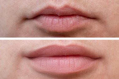 Female lips before and after augmentation, the result of using hyaluronic filler clipart