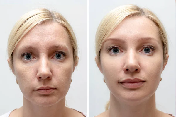 Woman face with wrinkles and age change before and after treatment - the result of rejuvenating cosmetological procedures of biorevitalization, face lifting and pigment spots removal — Stock Photo, Image