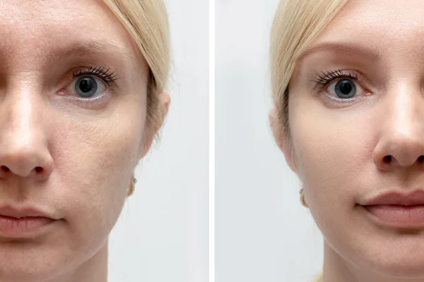 Woman face with wrinkles and age change before and after treatment - the result of rejuvenating cosmetological procedures of biorevitalization, face lifting and pigment spots removal — Stock Photo, Image