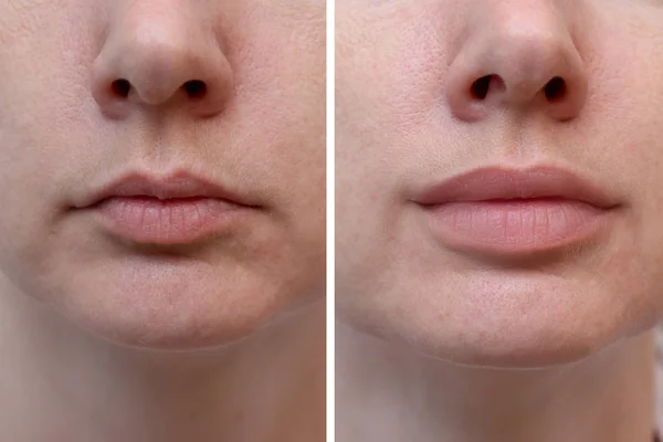 Bibir wanita sebelum dan sesudah augmentasi, hasil dari penggunaan pengisi hialuronik — Stok Foto