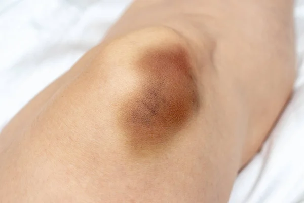 Uma grande contusão, extravasamento de hematoma na perna feminina, lesão no joelho — Fotografia de Stock