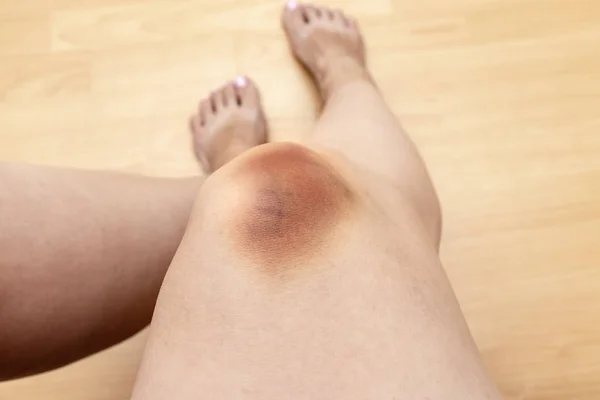 Une grosse ecchymose, une extravasation d'hématome sur la jambe féminine, une blessure au genou — Photo