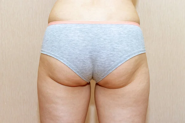 Mujer con sobrepeso, piernas y nalgas de celulitis grasa, obesidad cuerpo femenino sobre fondo claro — Foto de Stock