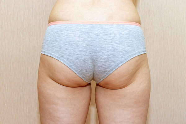 Overweight woman with fat cellulite legs and buttocks, obesity female body on light background