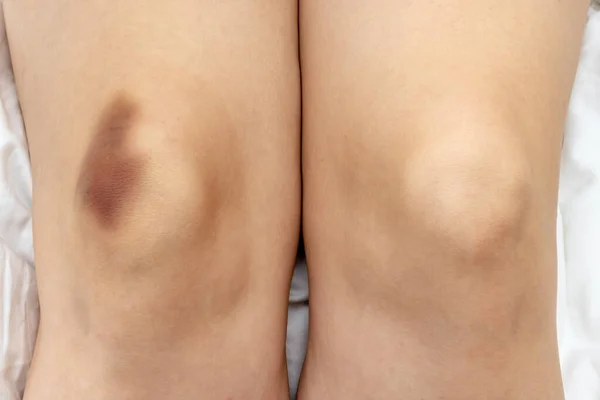 Une grosse ecchymose, une extravasation d'hématome sur la jambe féminine, une blessure au genou — Photo