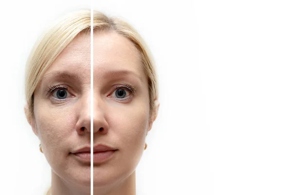 Woman face with wrinkles and age change before and after treatment - the result of rejuvenating cosmetological procedures of biorevitalization, face lifting and pigment spots removal, copy space — Stock Photo, Image