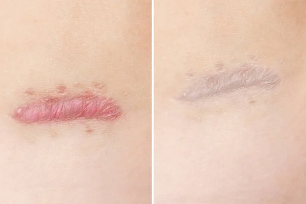 Close Von Zyanotischen Keloid Narben Die Durch Chirurgie Und Nähte — Stockfoto