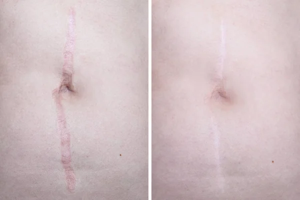 Cicatrice Kéloïde Hypertrophique Sur Visage Femme Avant Après Traitement Laser — Photo