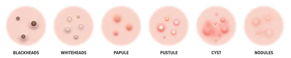 Tipi di acne, brufoli cutanei punti neri e comedoni facciali. Icone vettoriali di brufoli dell'acne della pelle, cosmetologia e problemi di cura della pelle — Vettoriale Stock
