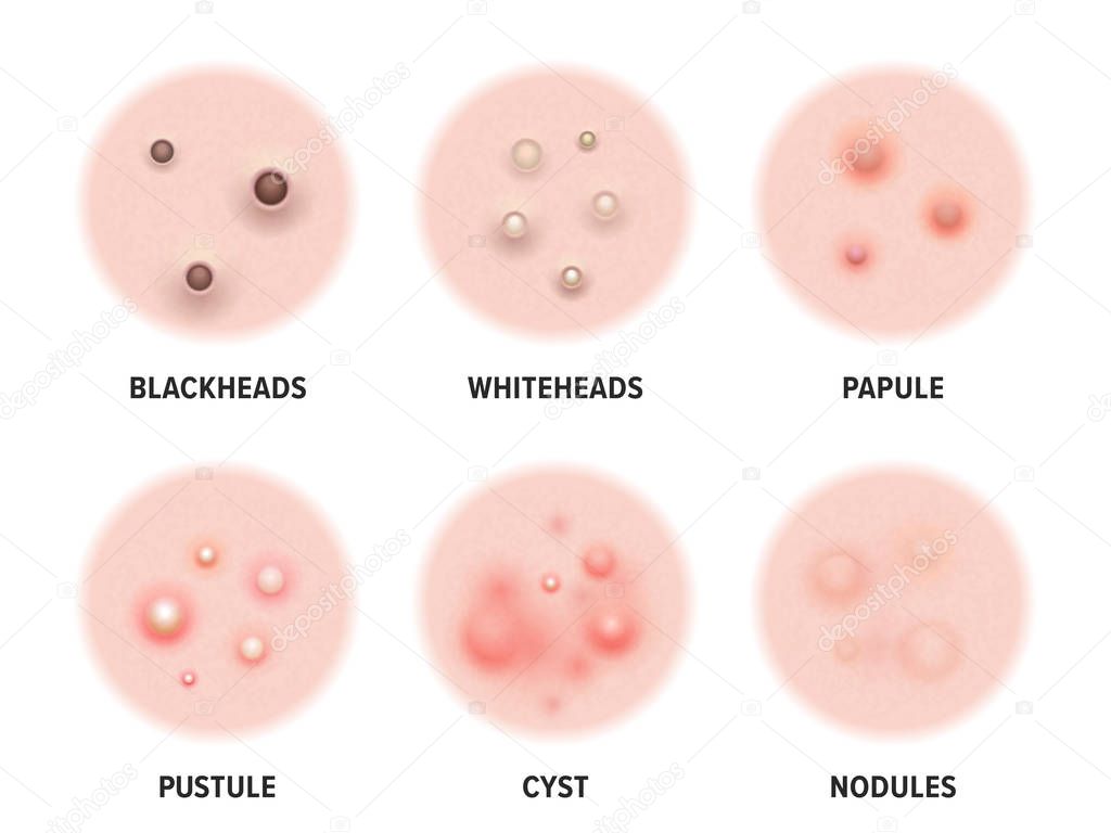 Skin acne types diagram. Vector skin disease pimples blackheads and comedones, cosmetology and skincare problems treatment