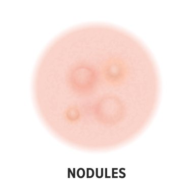 Nodüller cilt akne tipi vektör simgesi. Cilt hastalığı akne nodülleri sivilce tipi ve yüz gözenek comedones