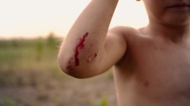 Childs'ın el, bir travma üzerinde erkek dirsek yıkılmasından sonra Childs'ın el kanıyla küçük taze yara