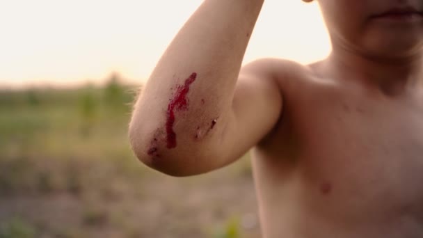 아이의 손, 소년 팔꿈치가 후에 외상, 자녀의 손에 혈액에 작은 신선한 스크래치 — 비디오