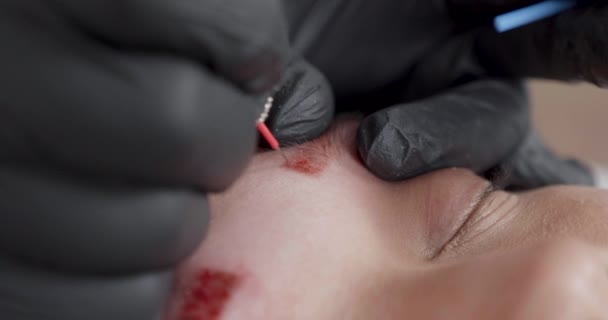 Closeup of an eyebrow during the process of eyebrow tattoo removal — Stock Video