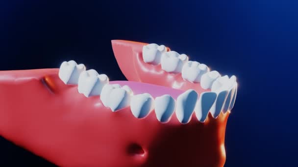 Tooth medical dental implant process — Stock Video