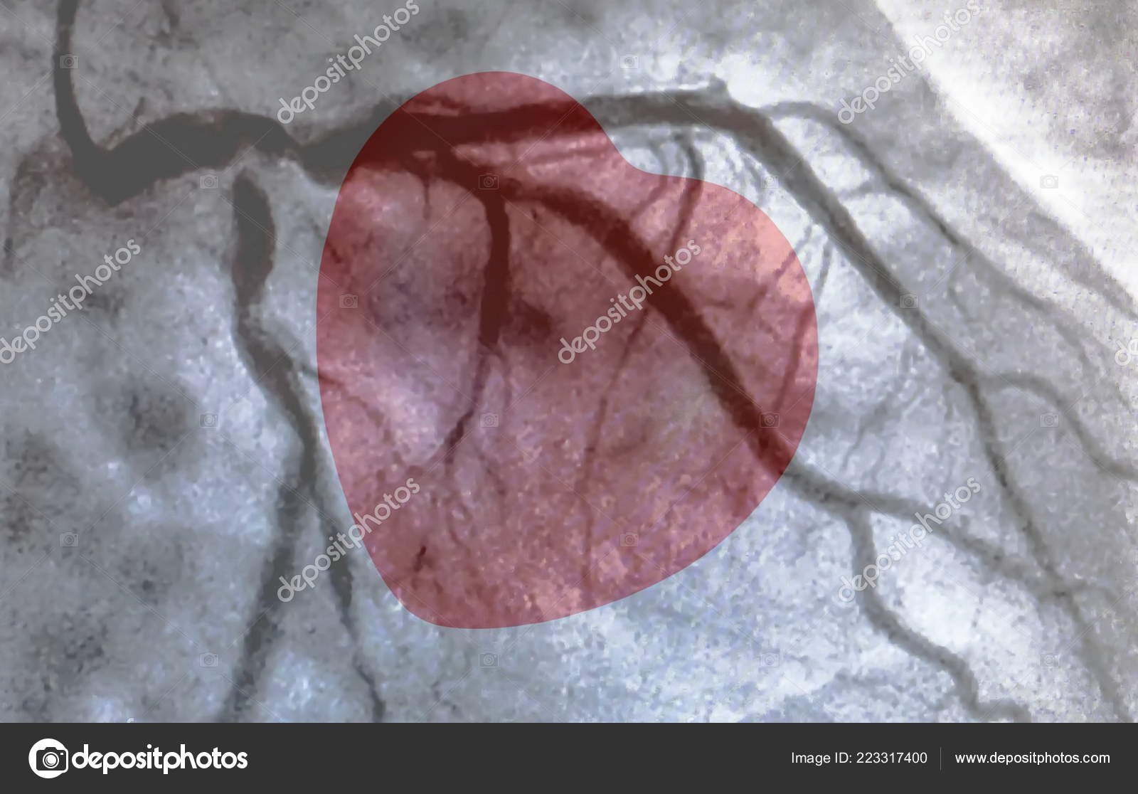 Catheterization Small Red Heart Cardiac Ventriculography Medical