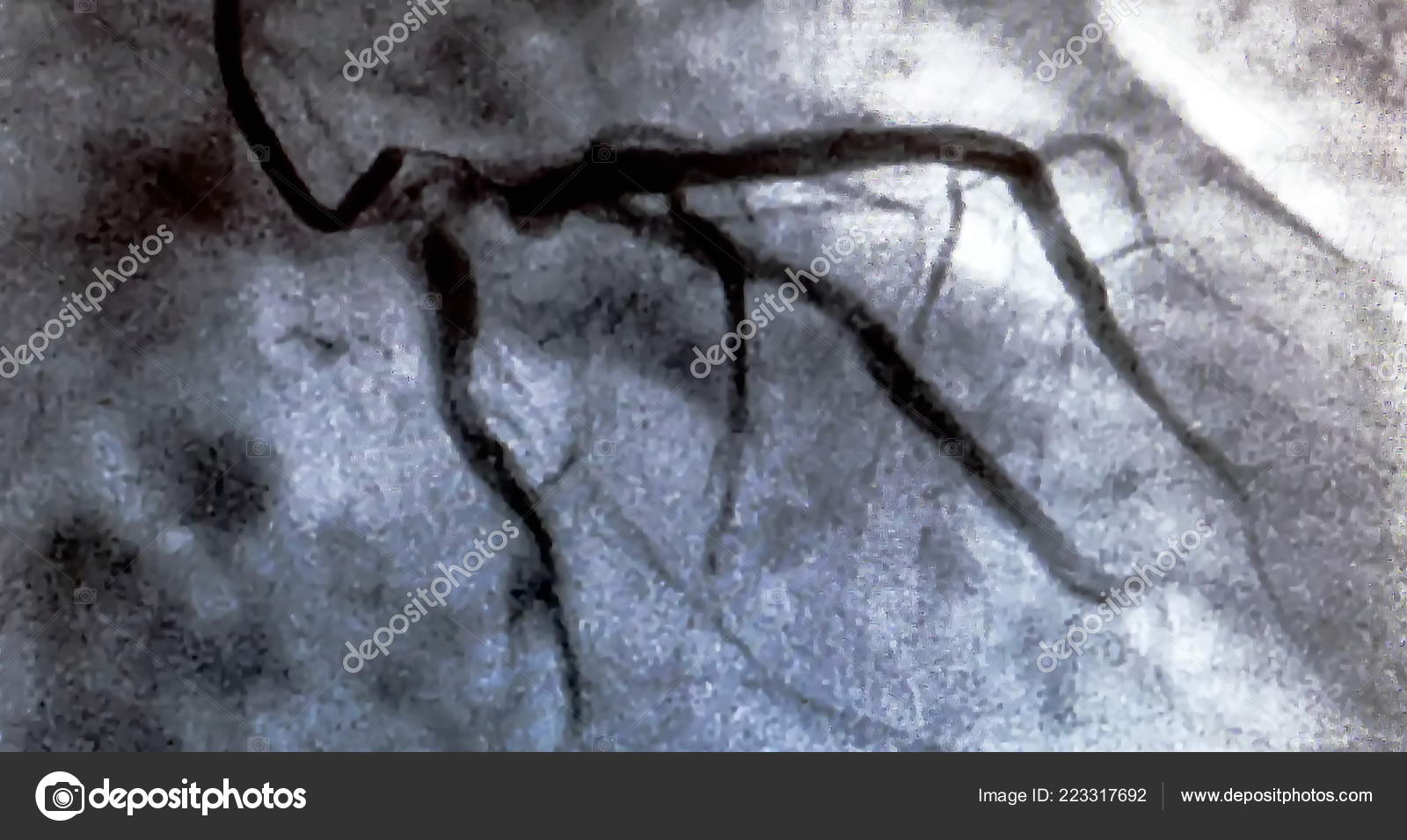 Catheterization Cardiac Ventriculography Medical Imaging Test Used
