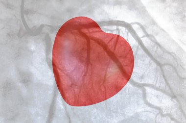 Kalp kateterizasyonu sırasında sol koroner arterin koroner arter anjiyogramı. Kateterizasyon. Kardiyak ventrikülografi hastanın kalp fonksiyonlarını belirlemek için kullanılan tıbbi bir görüntüleme testidir.