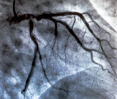 Kalp kateterizasyonu sırasında sol koroner arterin koroner arter anjiyogramı. Kateterizasyon. Kardiyak ventrikülografi hastanın kalp fonksiyonlarını belirlemek için kullanılan tıbbi bir görüntüleme testidir.