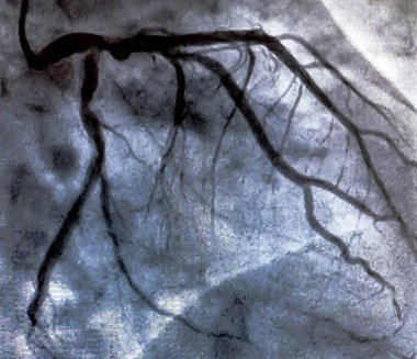 Kalp kateterizasyonu sırasında sol koroner arterin koroner arter anjiyogramı. Kateterizasyon. Kardiyak ventrikülografi hastanın kalp fonksiyonlarını belirlemek için kullanılan tıbbi bir görüntüleme testidir.