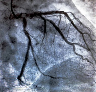Kalp kateterizasyonu sırasında sol koroner arterin koroner arter anjiyogramı. Kateterizasyon. Kardiyak ventrikülografi hastanın kalp fonksiyonlarını belirlemek için kullanılan tıbbi bir görüntüleme testidir.