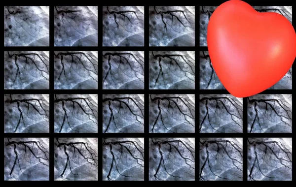 Bal Koszorúér Angiogramja Szívkatéterezés Alatt Katéterezés Szívkamra Vizsgálat Beteg Szívfunkciójának — Stock Fotó