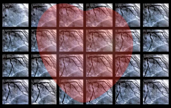 Катетеризация Маленькое Красное Сердце Сердечный Желудочек Медицинский Томограф Используемый Определения — стоковое фото
