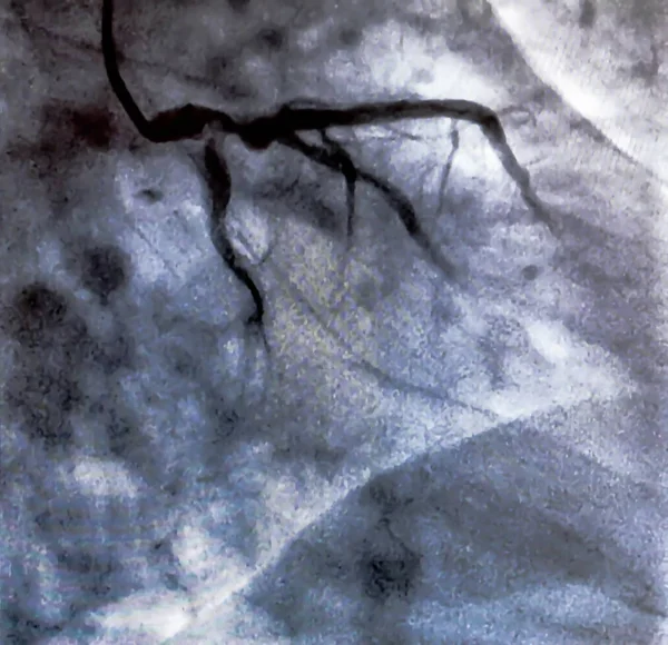 心脏脑室造影是一种医学影像学测试 用于确定患者在右心室或左心室的心功能 — 图库照片