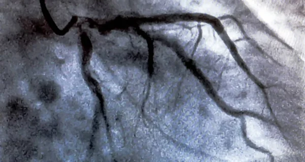 Angiographie Coronarienne Artère Coronaire Gauche Pendant Cathétérisme Cardiaque Cathétérisme Ventriculographie — Photo